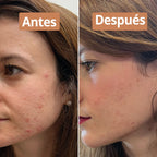 Sérum Facial Anti-imperfeições - Comme Avant